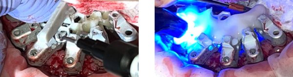 Opti Splint OPTISPLINT®