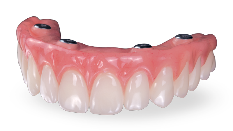 Screw-Retained Hybrid Denture Image