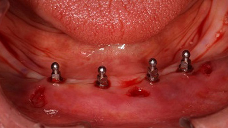 Postoperative clinical view of four small-diameter Inclusive Mini Implants 