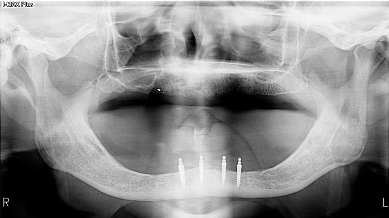 Panoramic radiograph of the four small-diameter Inclusive Mini Implants