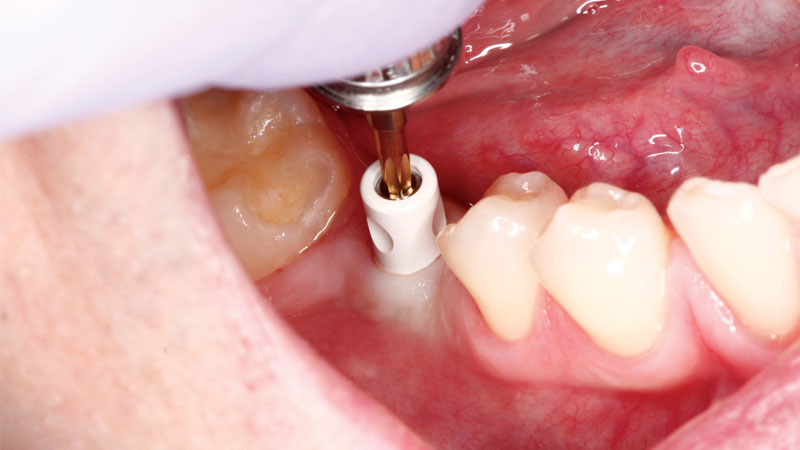 Connet abutment by using hand driver