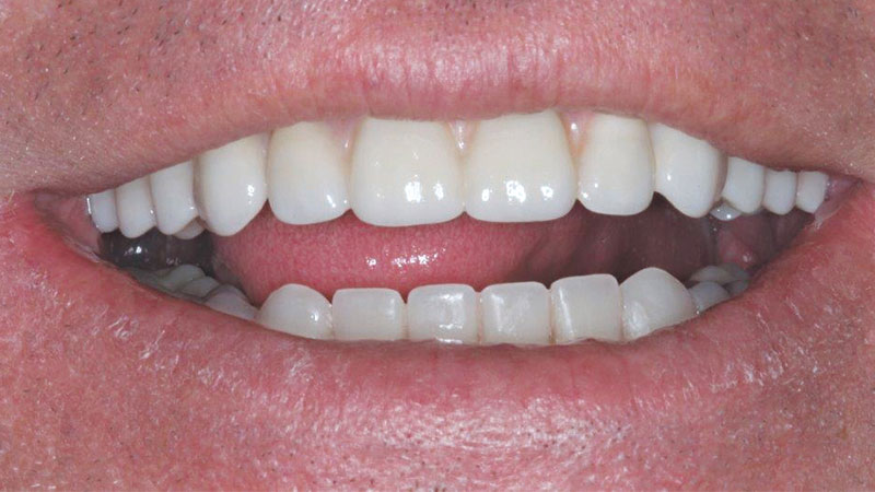 The abutments addressed molar to molar restoration image