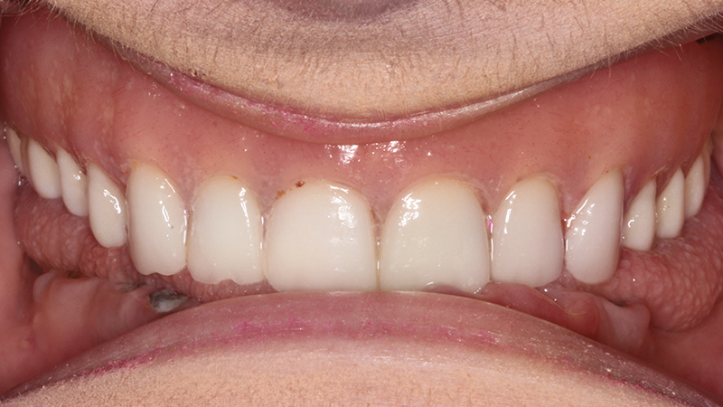 Before image of patient with loose-fitting upper denture
