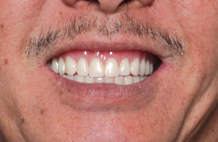 Before image of patient with implants and temporary healing dentures