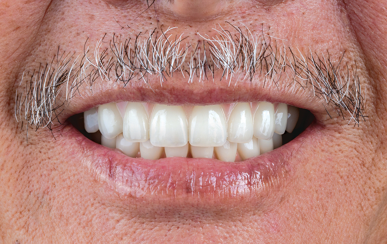 After image of patient with restored dental implants