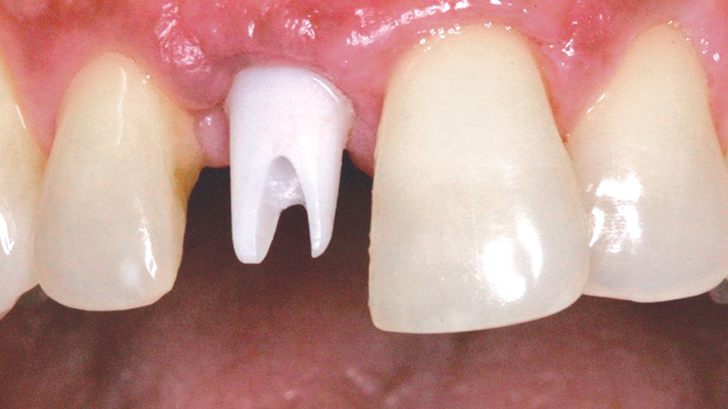 Implant was placed to restore an upper central incisor