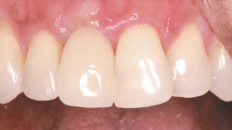 A final BruxZir® Solid Zirconia crown was delivered over the zirconia custom abut­ment with titanium base