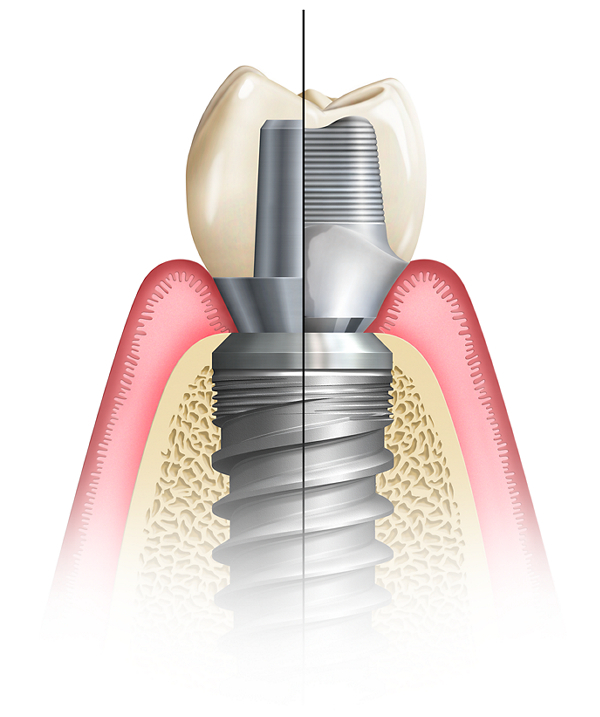 Glidewell Custom Abutment Implant Lab Predictable Results