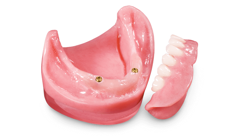 Locator® Overdenture product image