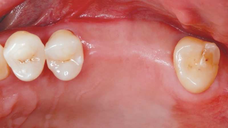 Before photo of patient with extracted teeth #14-15