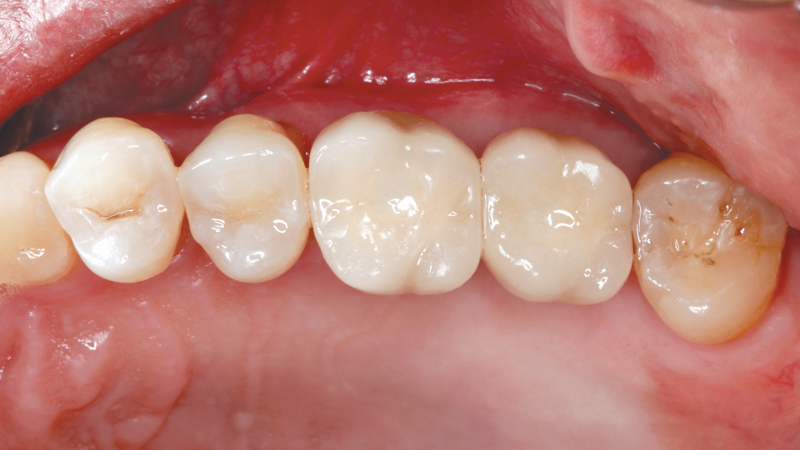 After photo with two Hahn Tapered Implants and restored with Obsidian Fused to Metal screw-retained crowns
