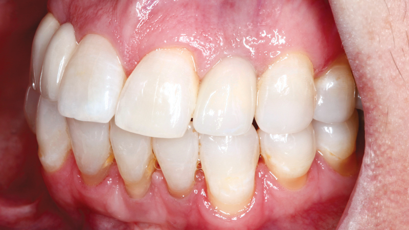 BruxZir Esthetic screw-retained crown was placed over the implant