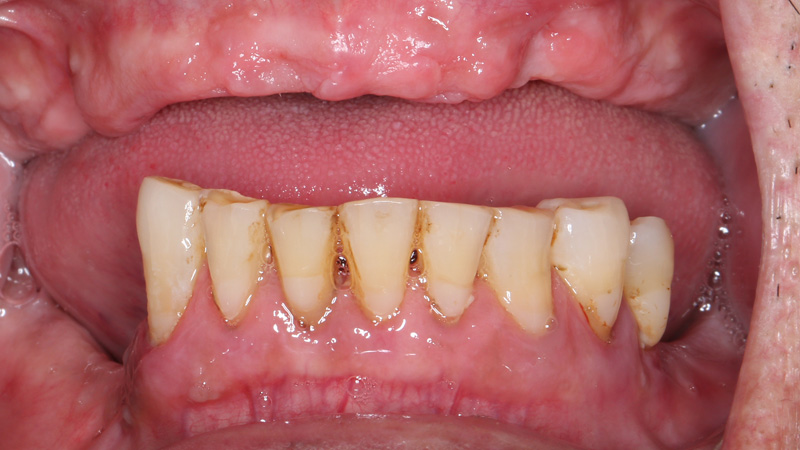 BEFORE: The patient presented for treatment with an edentulous upper arch and a terminal prognosis for his remaining lower teeth