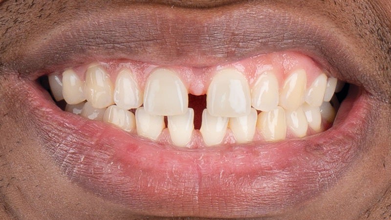 patient with spaces between teeth #8 and #9