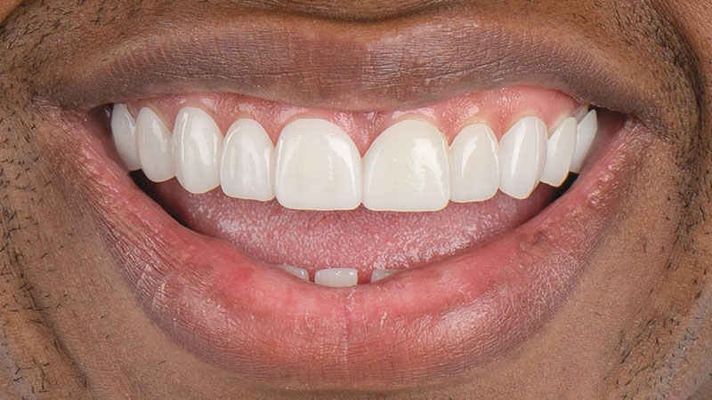 Smile Transitions helped patient and eliminated the gap