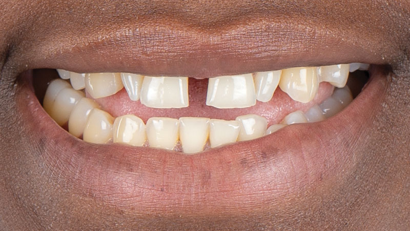 patient before using Smile Transitions