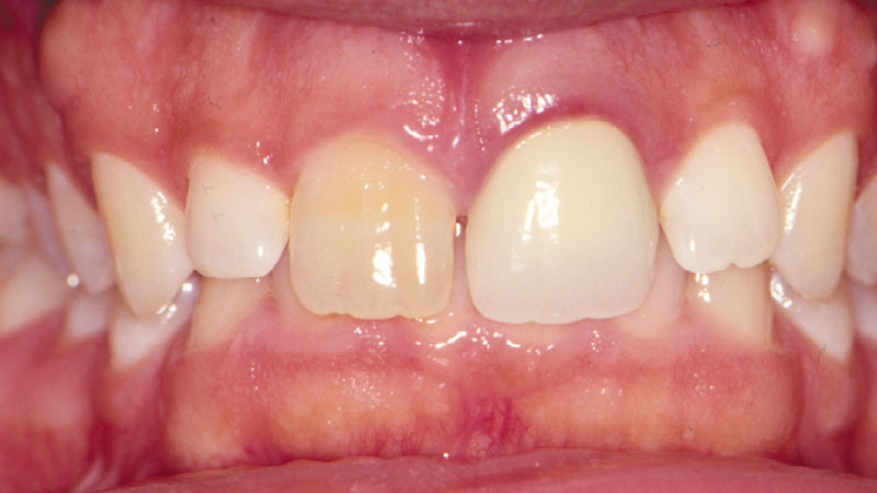 Patient suffering from discolored upper right central PFM