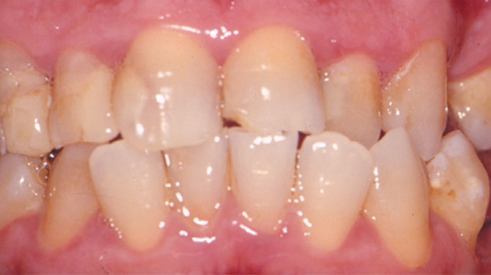 Patient with recurrent caries and missing teeth in posterior quadrants