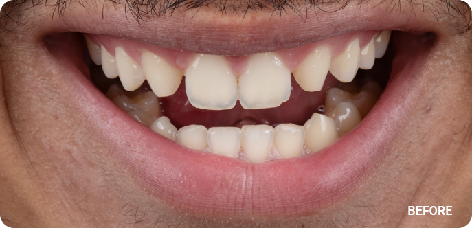 TrialSmile (Before)