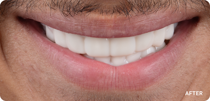 TrialSmile (After)