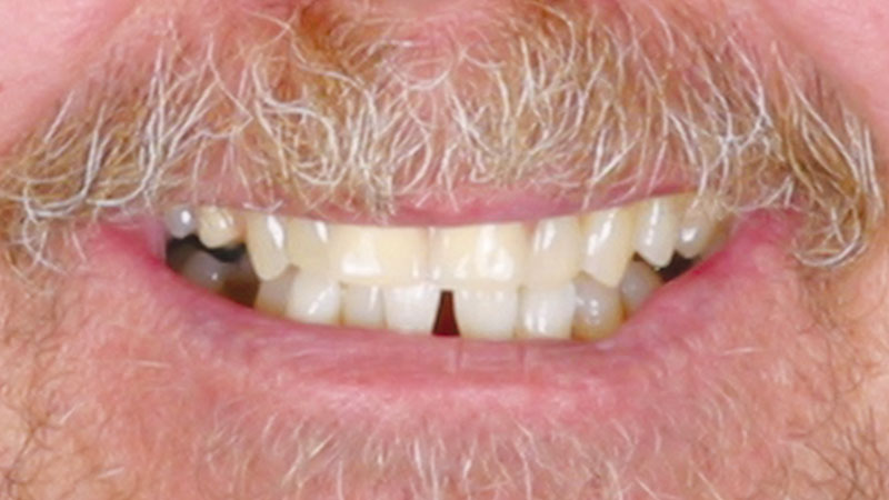 Metal-Free Removable Partials at Glidewell Denture Lab