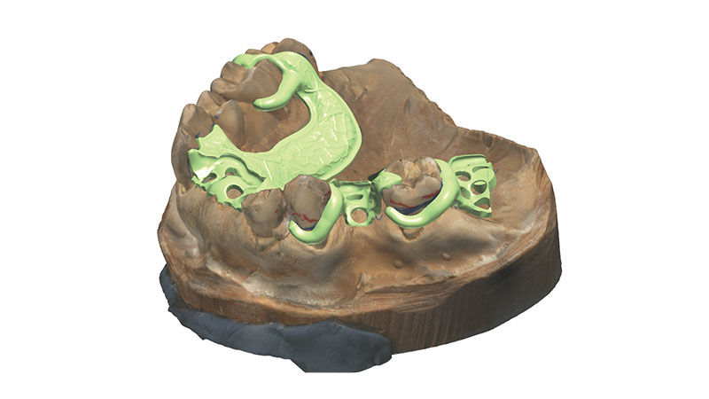 Metal-Free Removable Partials at Glidewell Denture Lab