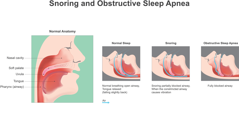 What snoring and obstructive sleep apnea looks like